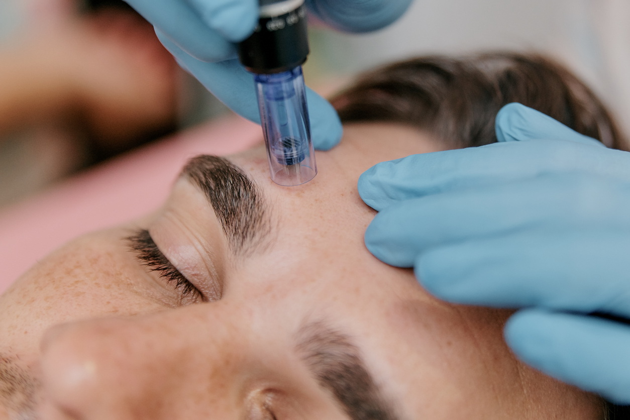 Microneedling Services
